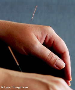 Acupuncture